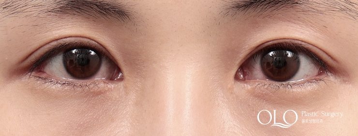 GL밑트임복원,안검내반,앞트임복원 수술후 11개월