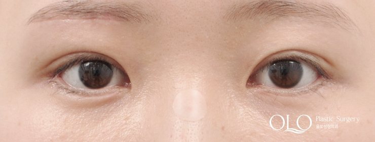 GL밑트임복원,눈썹거상술(한쪽),안검내반 수술후 1개월