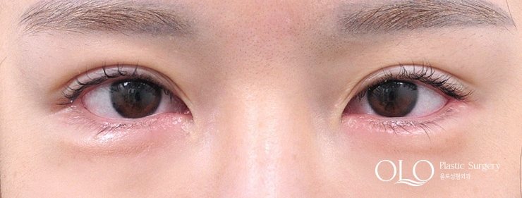 GL밑트임복원,안검내반 수술후 7일차