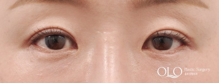 GL밑트임복원,안검내반 수술후 1개월