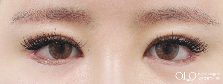 GL밑트임복원,안검내반 3주차