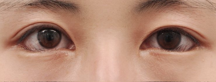 GL밑트임복원,안검내반,앞트임복원 수술 전