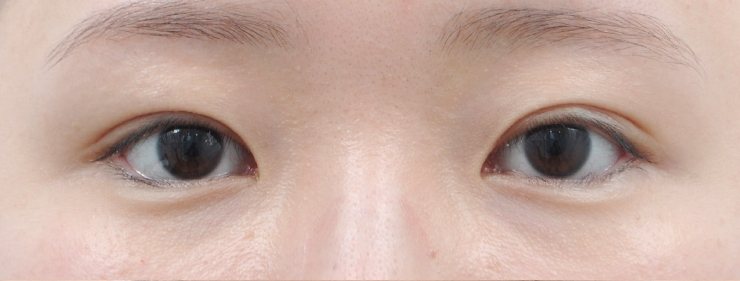 GL밑트임복원,눈썹거상술(한쪽),안검내반 수술 전