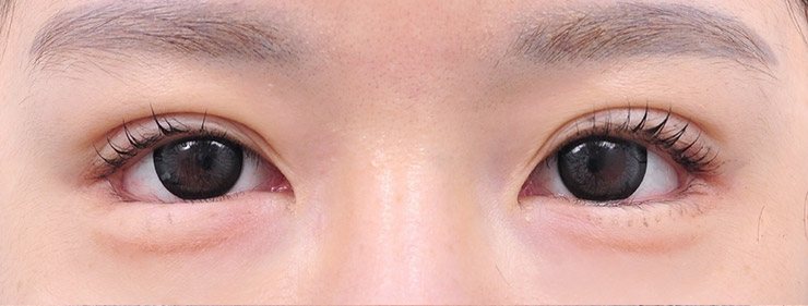 GL밑트임복원,안검내반 수술 전