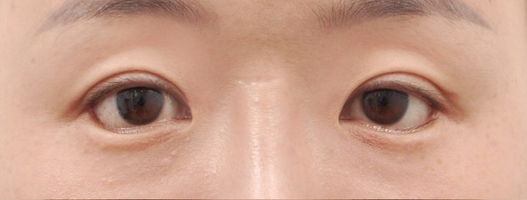 GL밑트임복원,안검내반 수술 전