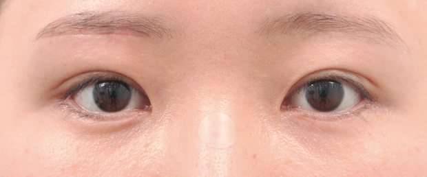 CASE 01 수술 후 — 최소 절개 복원으로 자연스러운 눈매