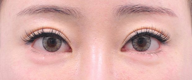 CASE 03 수술 후 — 정밀한 복원으로 안정된 눈매